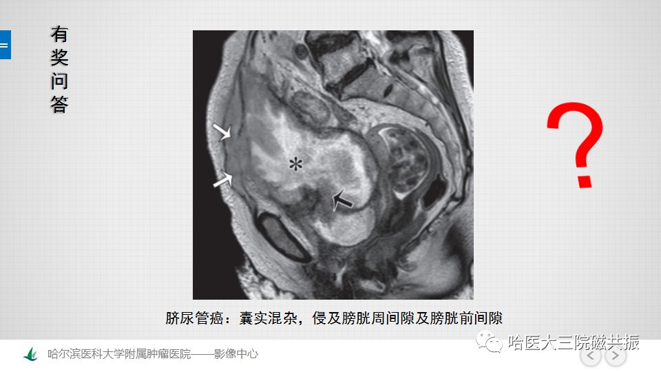 【PPT】女性盆腔肿瘤及肿瘤样变诊断思路分析—基于解剖位置