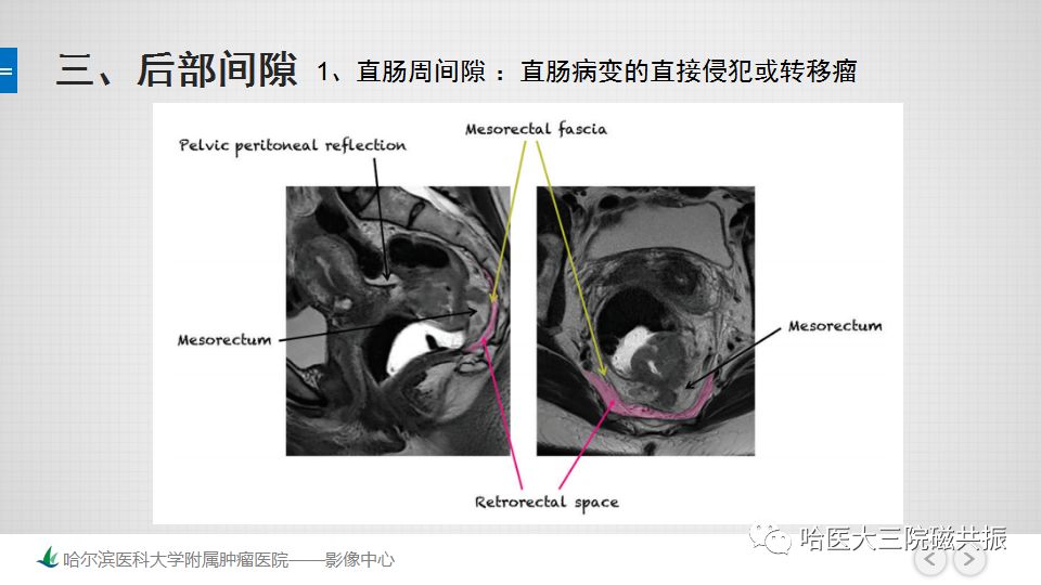 【PPT】女性盆腔肿瘤及肿瘤样变诊断思路分析—基于解剖位置