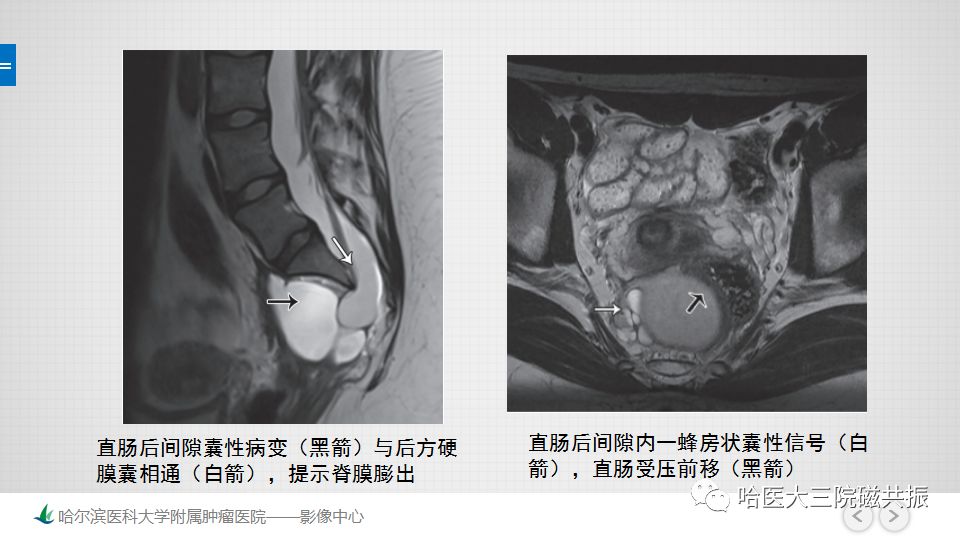 【PPT】女性盆腔肿瘤及肿瘤样变诊断思路分析—基于解剖位置