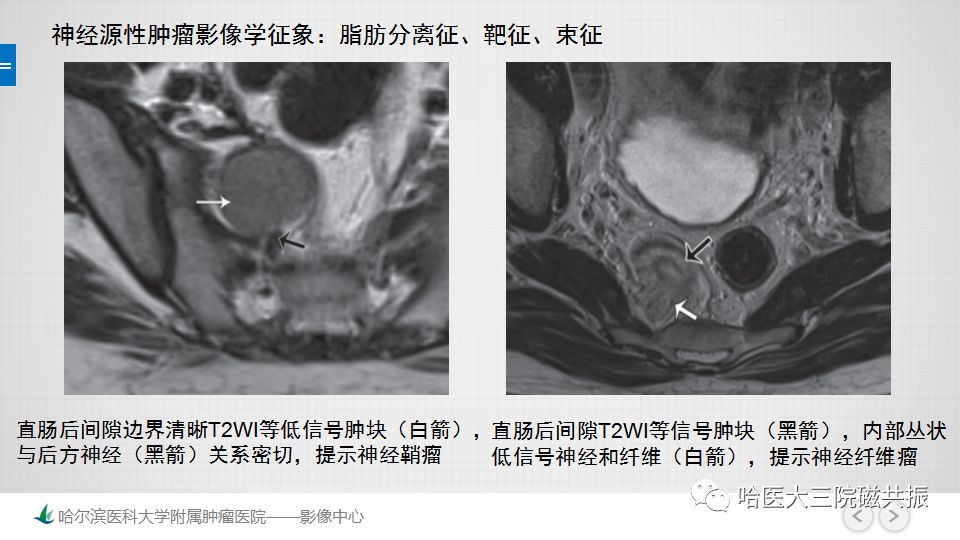 【PPT】女性盆腔肿瘤及肿瘤样变诊断思路分析—基于解剖位置