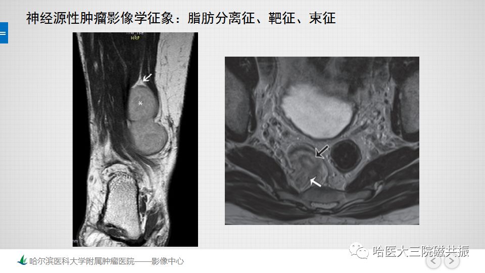 【PPT】女性盆腔肿瘤及肿瘤样变诊断思路分析—基于解剖位置