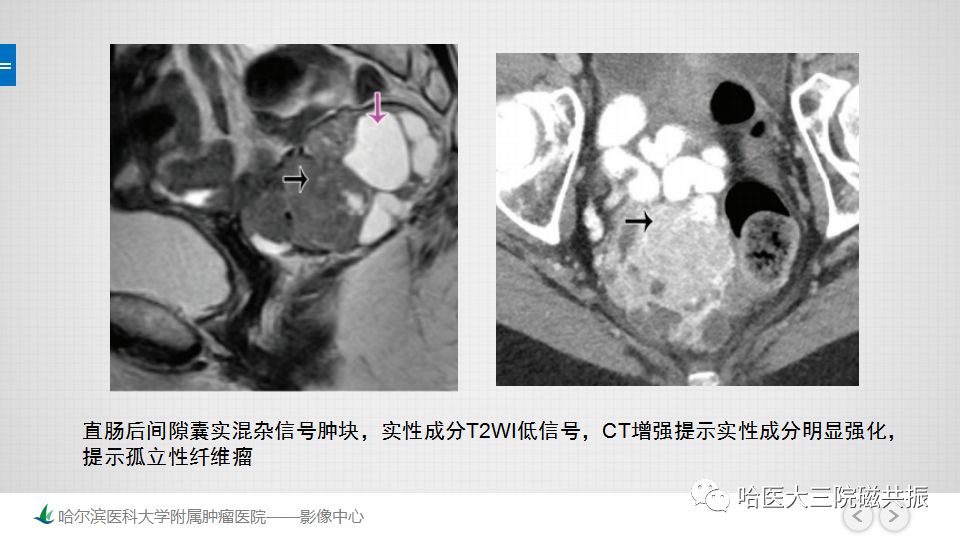 【PPT】女性盆腔肿瘤及肿瘤样变诊断思路分析—基于解剖位置