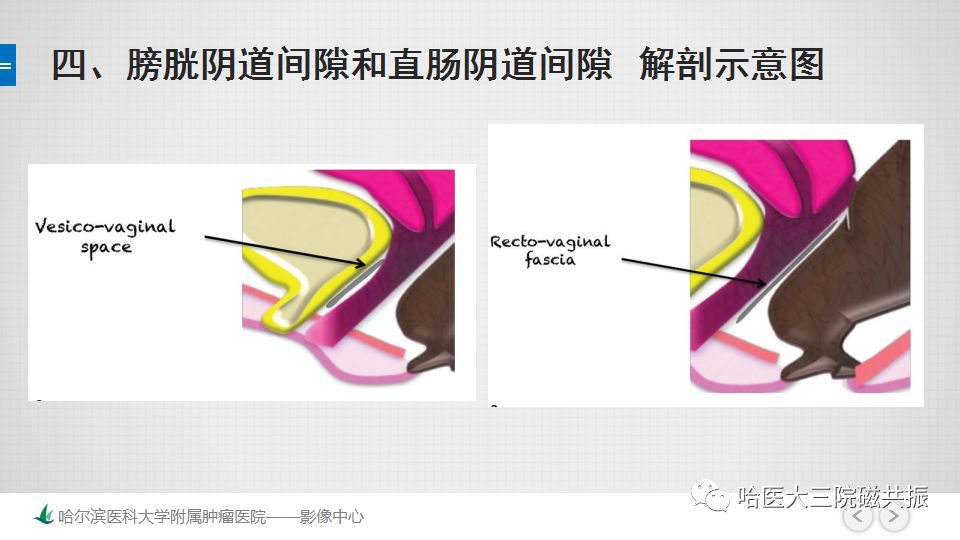 【PPT】女性盆腔肿瘤及肿瘤样变诊断思路分析—基于解剖位置