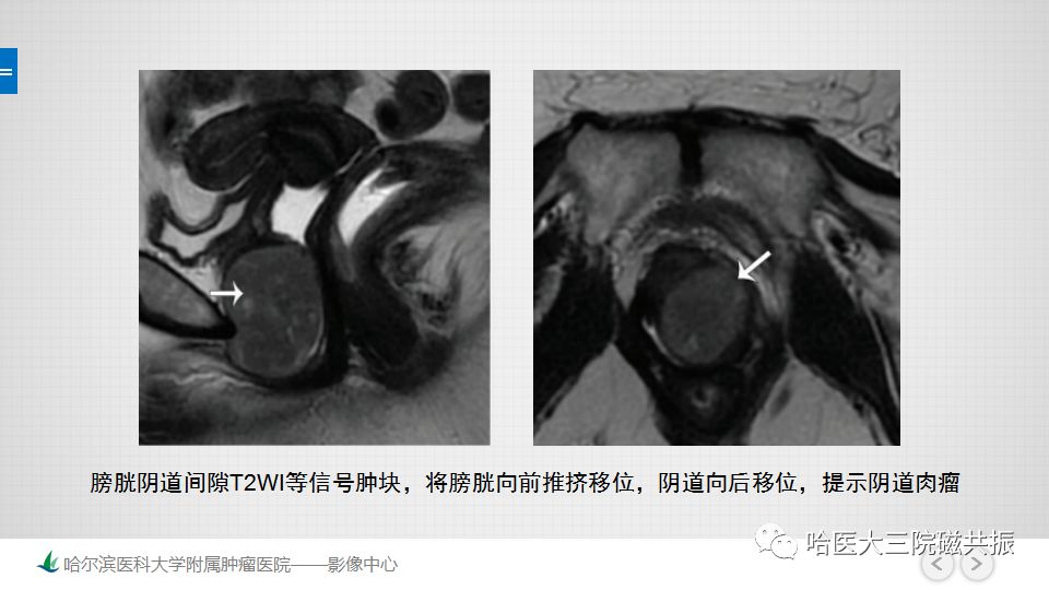 【PPT】女性盆腔肿瘤及肿瘤样变诊断思路分析—基于解剖位置