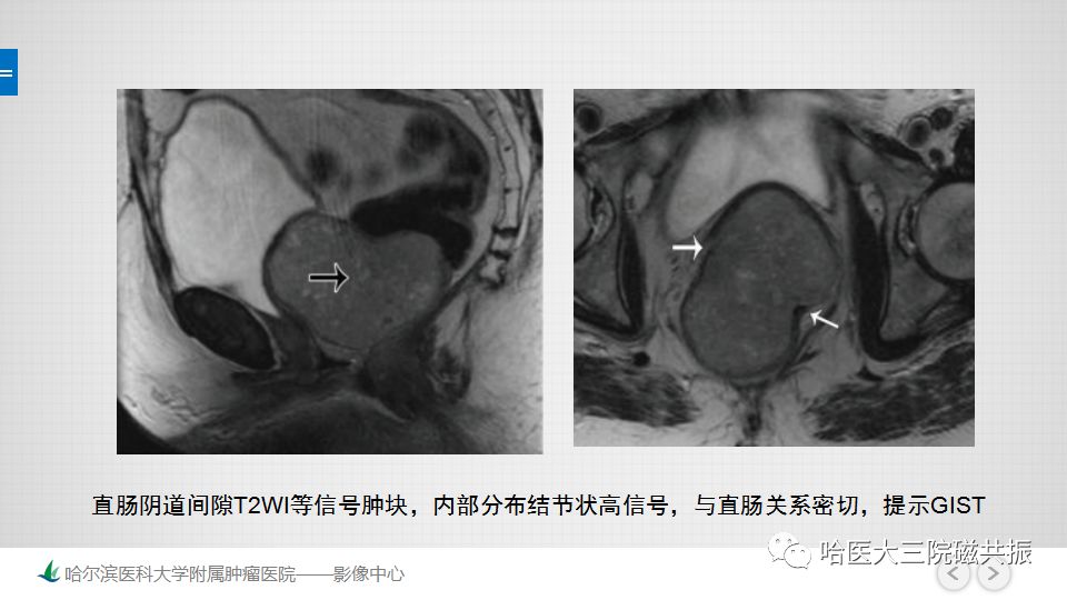 【PPT】女性盆腔肿瘤及肿瘤样变诊断思路分析—基于解剖位置