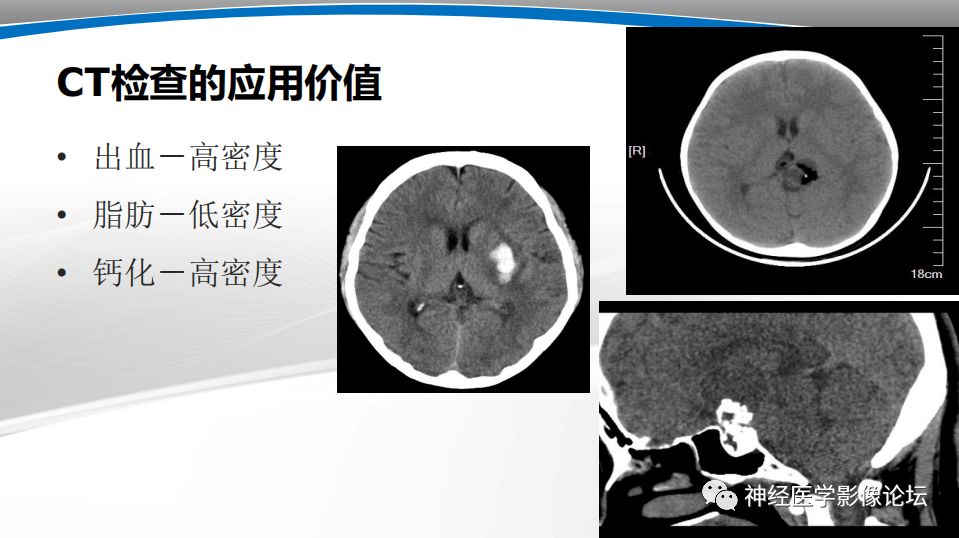 【PPT】颅内短T1信号的MRI鉴别诊断