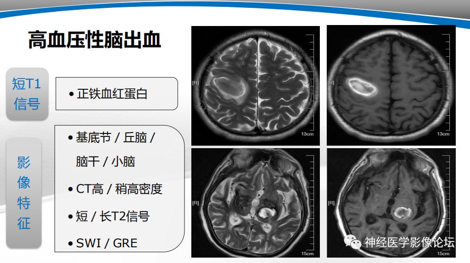 【PPT】颅内短T1信号的MRI鉴别诊断