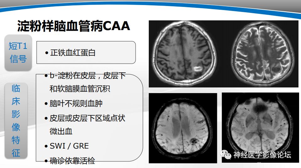 【PPT】颅内短T1信号的MRI鉴别诊断