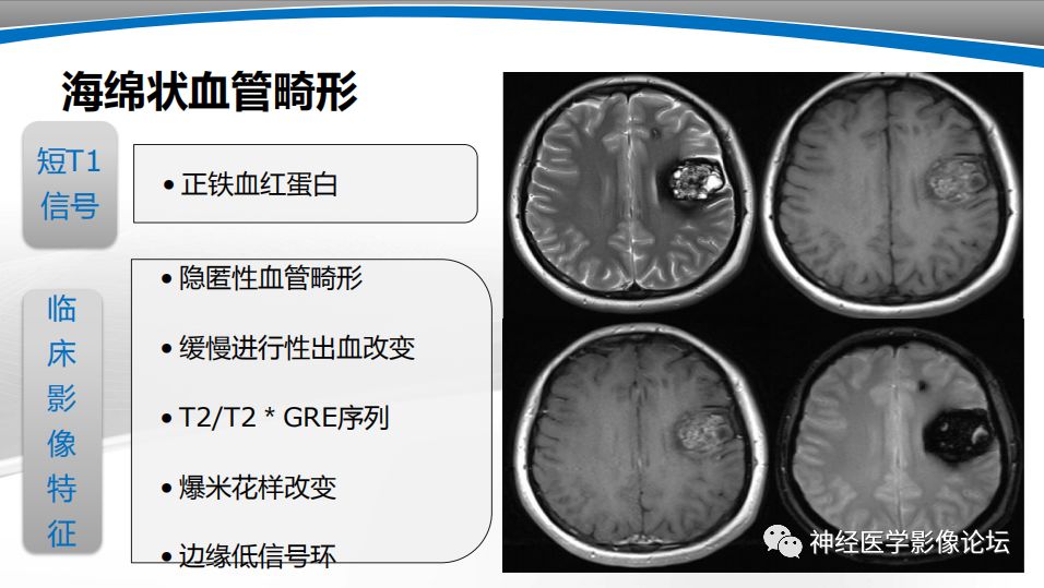 【PPT】颅内短T1信号的MRI鉴别诊断