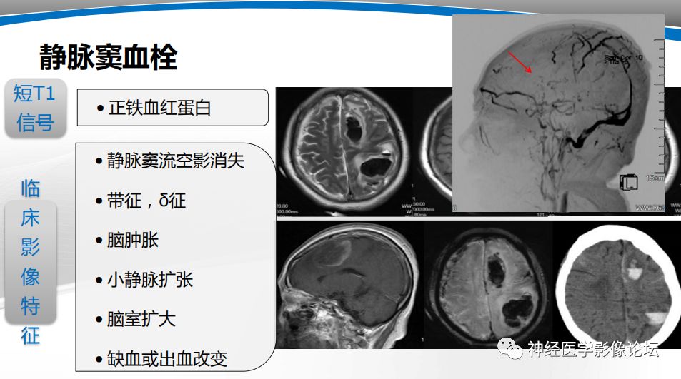 【PPT】颅内短T1信号的MRI鉴别诊断