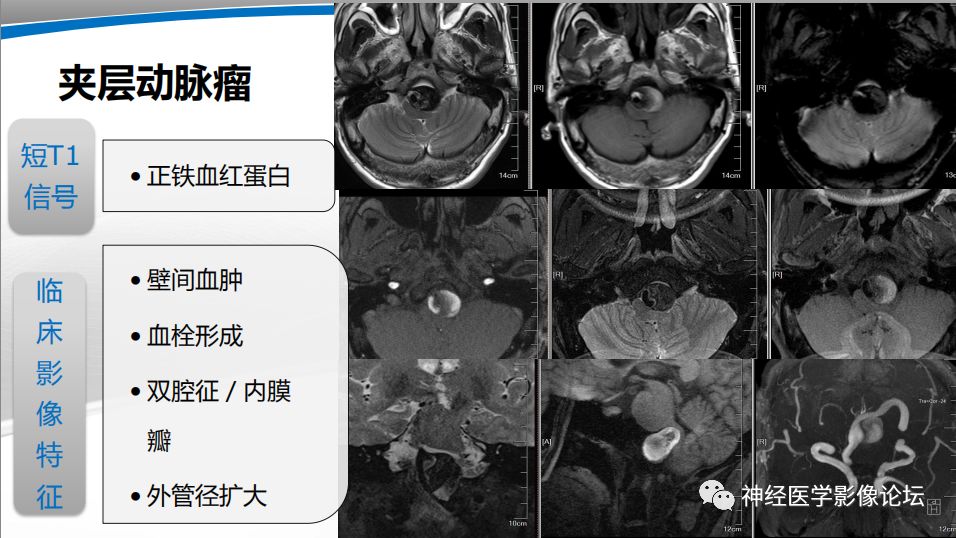 【PPT】颅内短T1信号的MRI鉴别诊断
