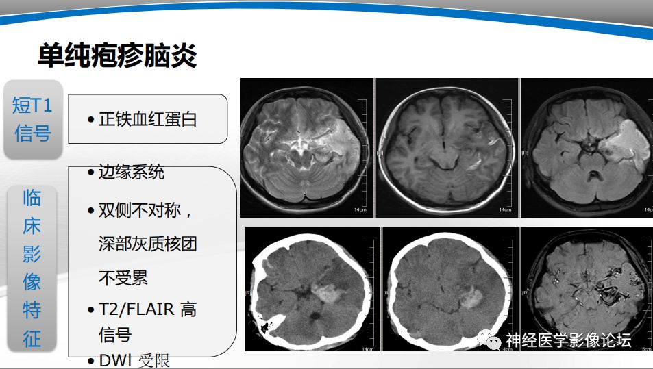 【PPT】颅内短T1信号的MRI鉴别诊断