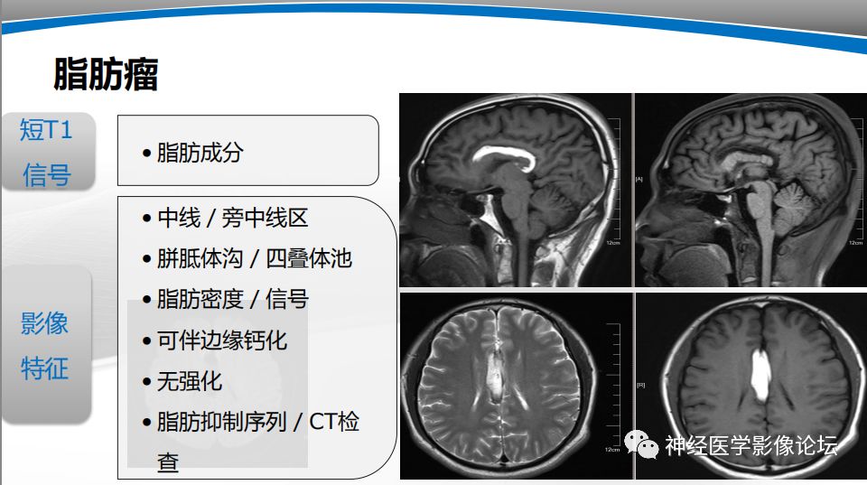 【PPT】颅内短T1信号的MRI鉴别诊断