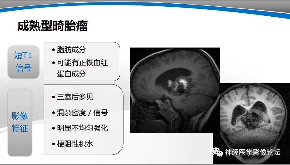 【PPT】颅内短T1信号的MRI鉴别诊断