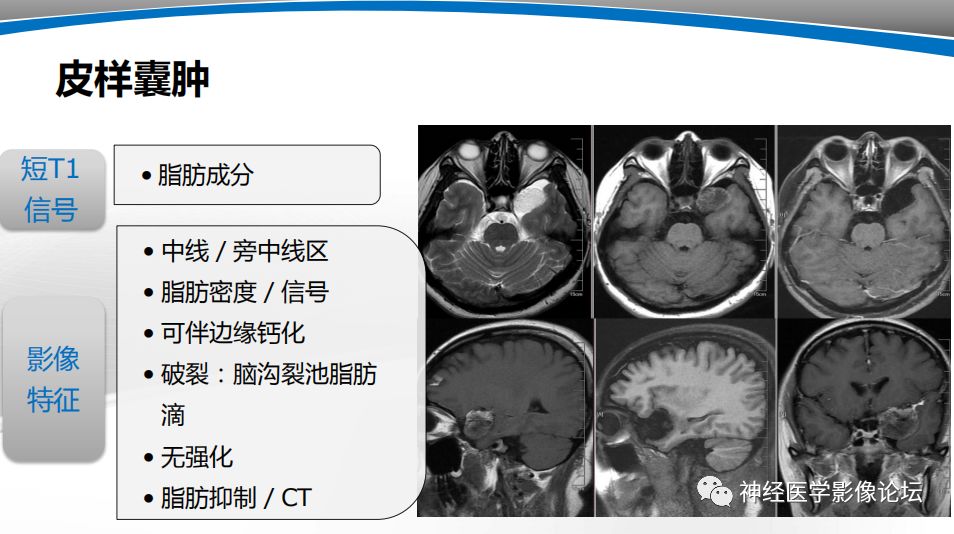 【PPT】颅内短T1信号的MRI鉴别诊断
