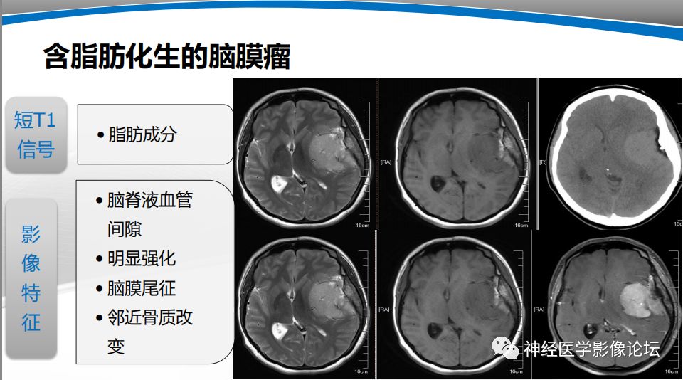 【PPT】颅内短T1信号的MRI鉴别诊断