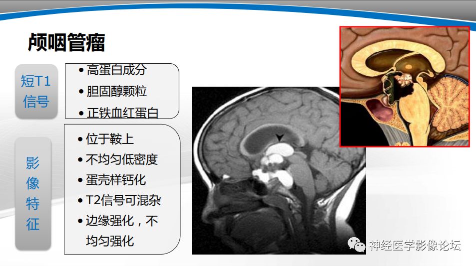 【PPT】颅内短T1信号的MRI鉴别诊断