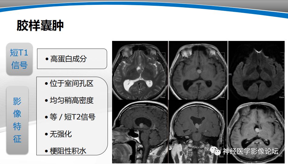 【PPT】颅内短T1信号的MRI鉴别诊断