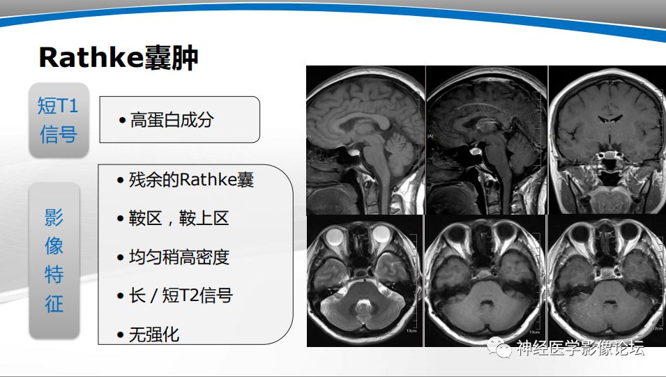 【PPT】颅内短T1信号的MRI鉴别诊断