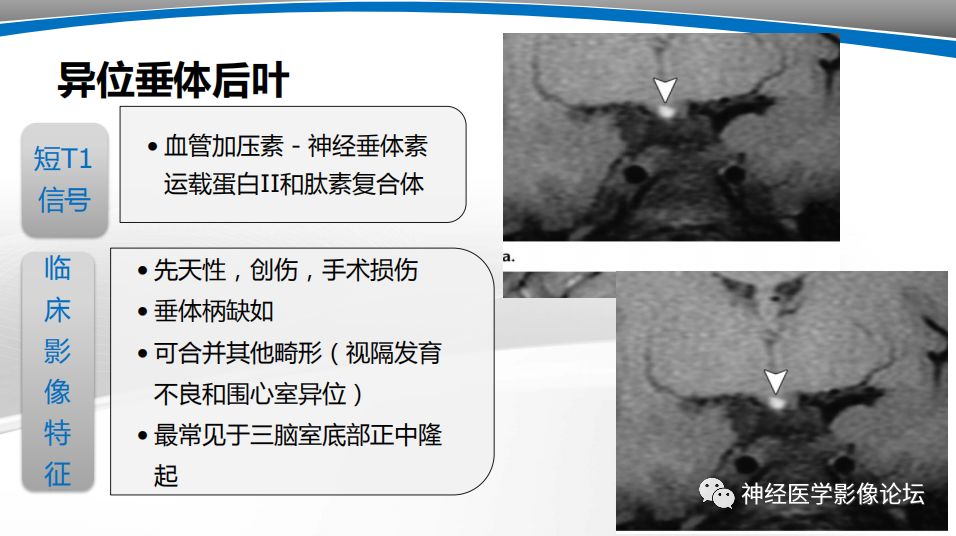 【PPT】颅内短T1信号的MRI鉴别诊断