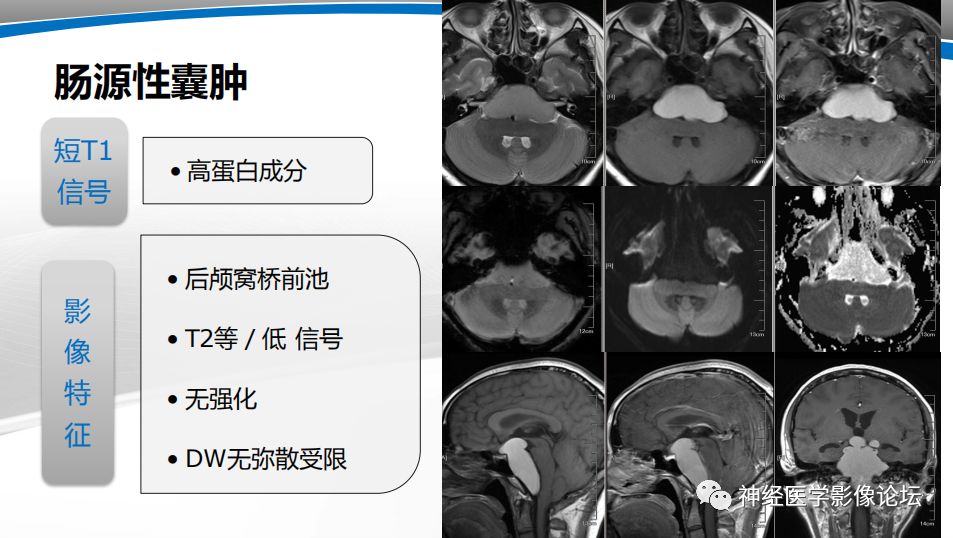 【PPT】颅内短T1信号的MRI鉴别诊断
