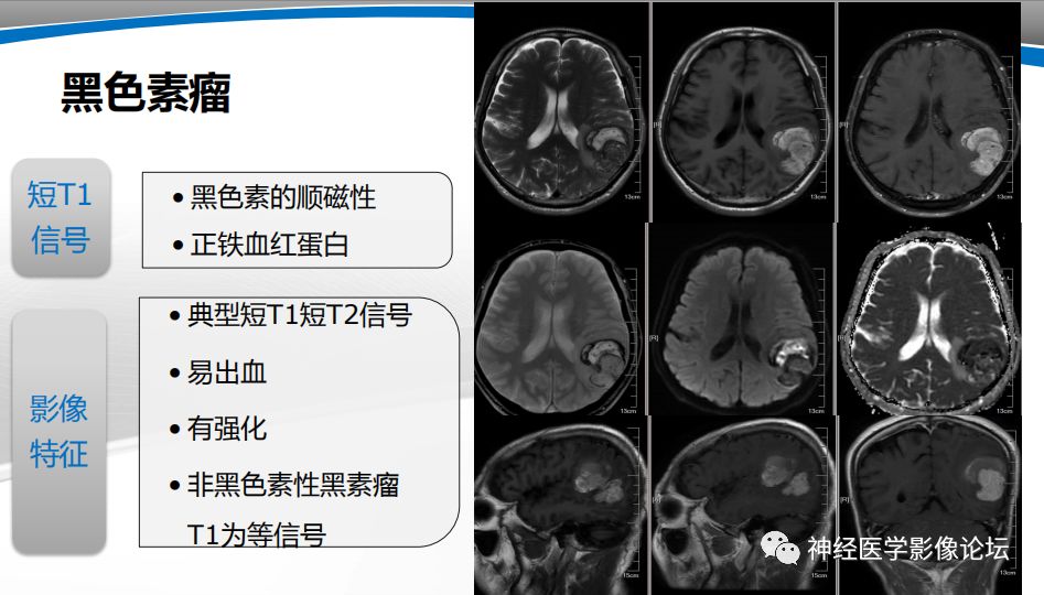 【PPT】颅内短T1信号的MRI鉴别诊断