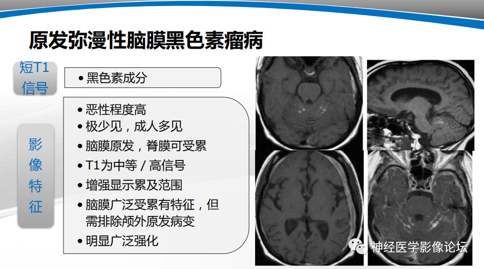 【PPT】颅内短T1信号的MRI鉴别诊断