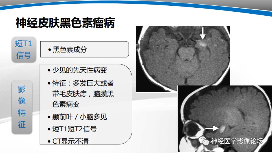 【PPT】颅内短T1信号的MRI鉴别诊断