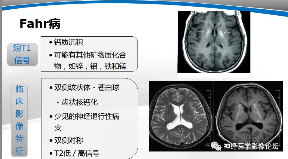 【PPT】颅内短T1信号的MRI鉴别诊断