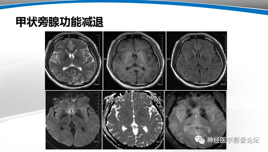 【PPT】颅内短T1信号的MRI鉴别诊断