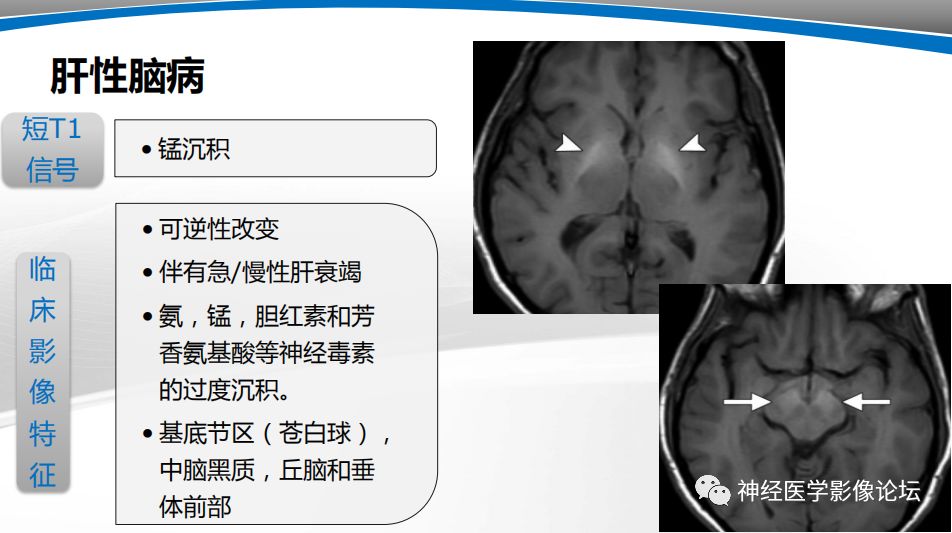 【PPT】颅内短T1信号的MRI鉴别诊断