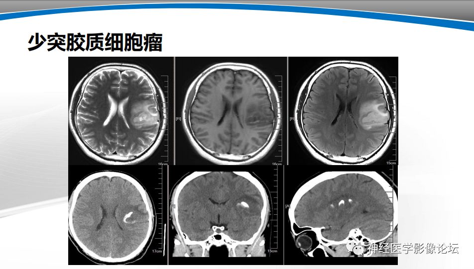 【PPT】颅内短T1信号的MRI鉴别诊断