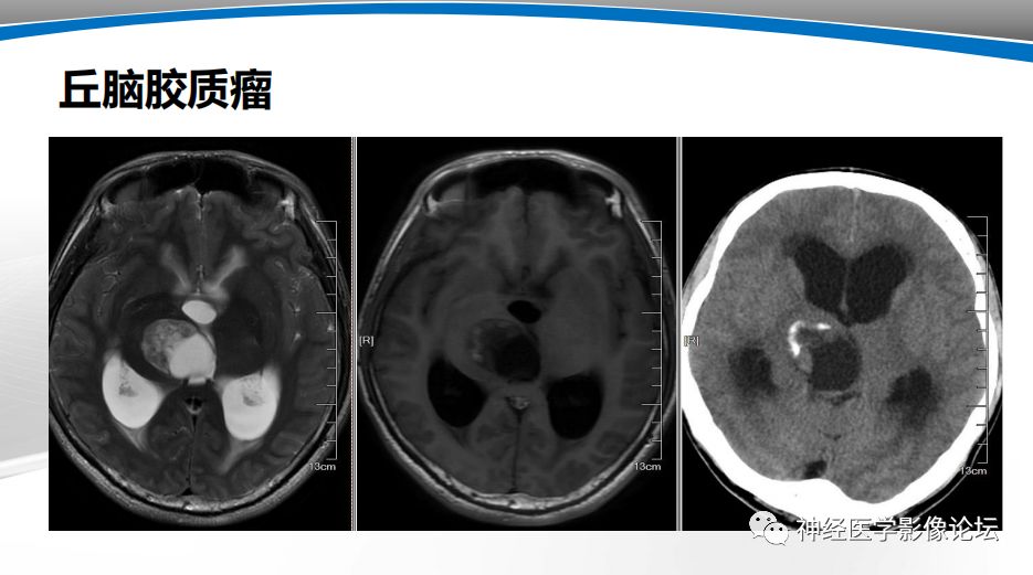 【PPT】颅内短T1信号的MRI鉴别诊断