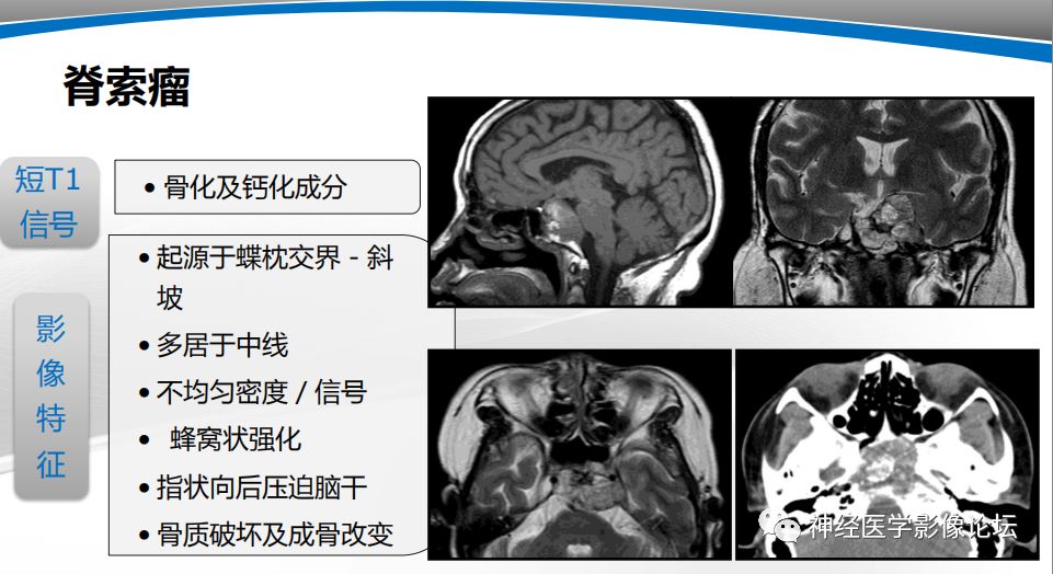 【PPT】颅内短T1信号的MRI鉴别诊断
