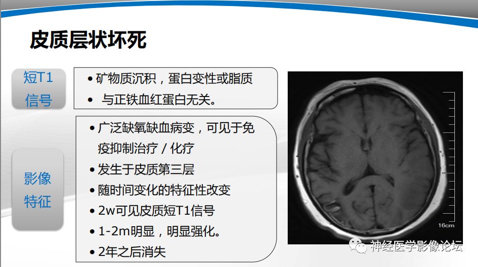 【PPT】颅内短T1信号的MRI鉴别诊断