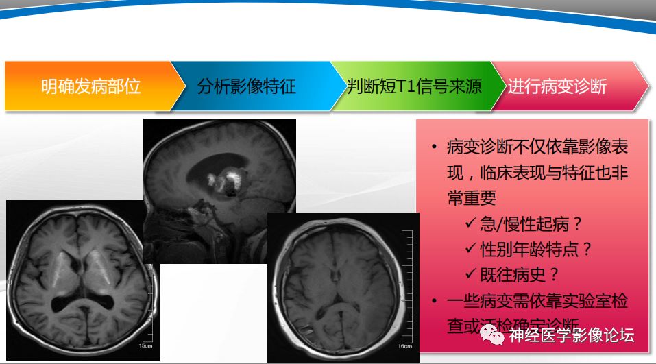 【PPT】颅内短T1信号的MRI鉴别诊断