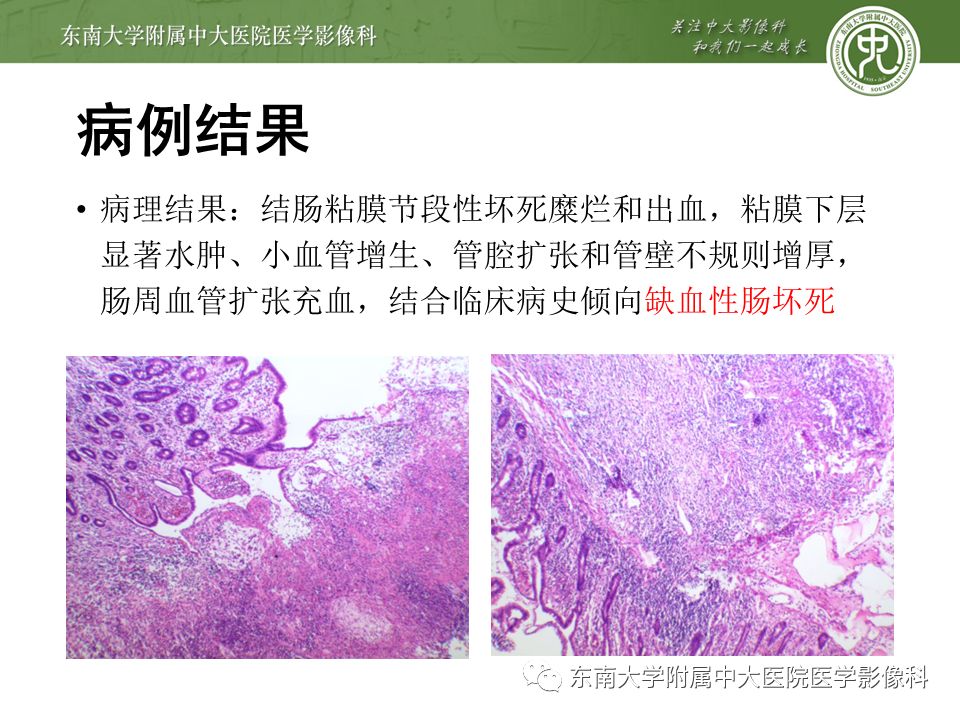 【PPT】门静脉积气影像表现及临床相关