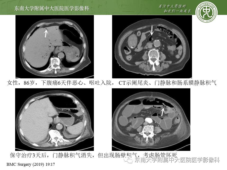 【PPT】门静脉积气影像表现及临床相关