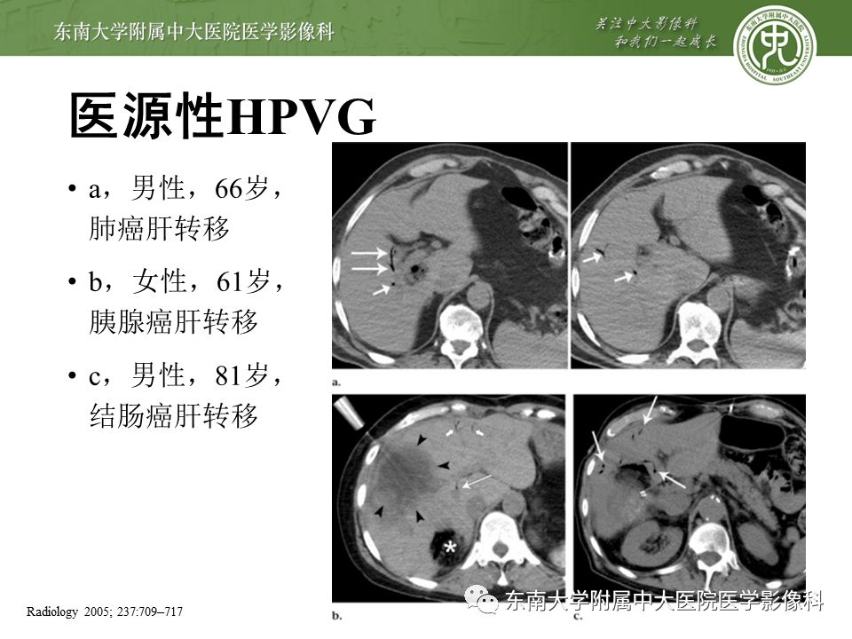 【PPT】门静脉积气影像表现及临床相关