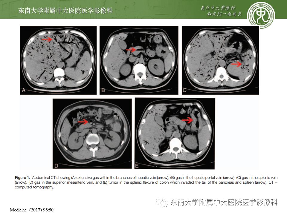 【PPT】门静脉积气影像表现及临床相关