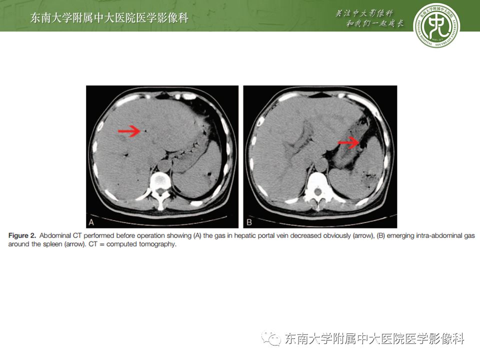 【PPT】门静脉积气影像表现及临床相关