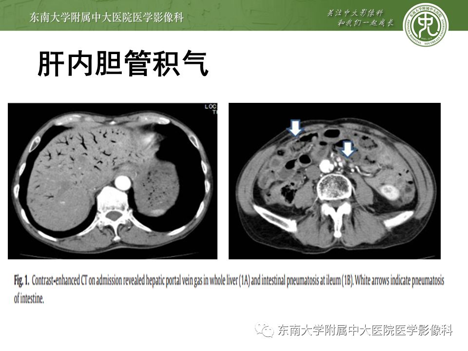 【PPT】门静脉积气影像表现及临床相关