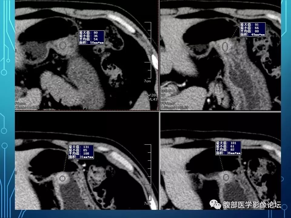 【病例】胃异位胰腺1例CT影像