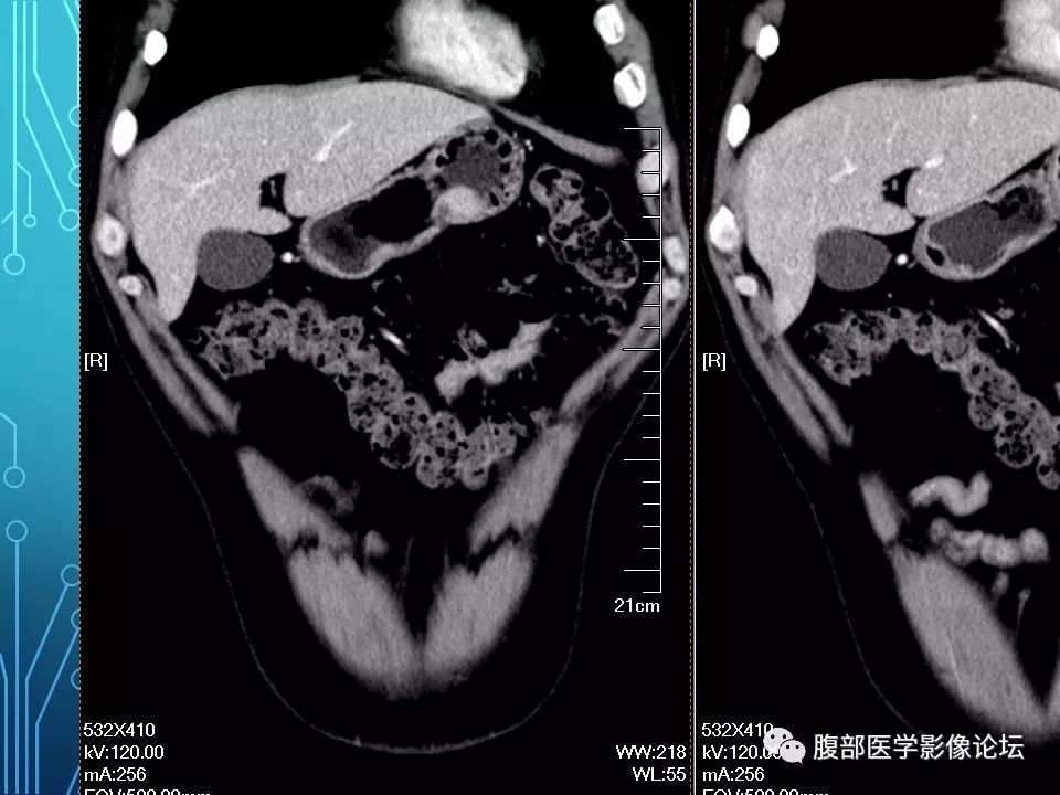 【病例】胃异位胰腺1例CT影像