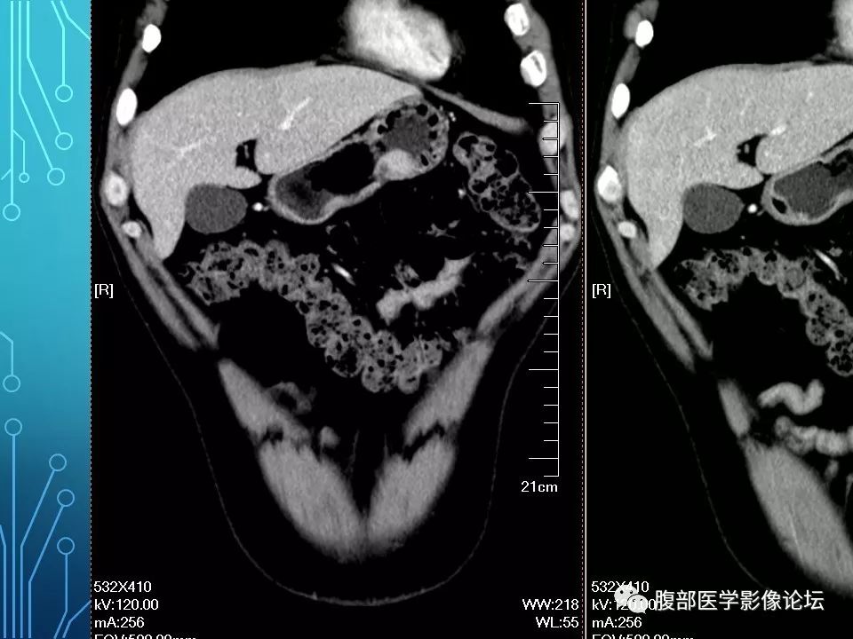 【病例】胃异位胰腺1例CT影像