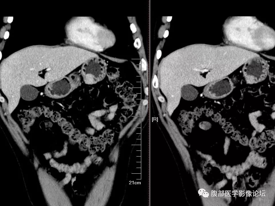 【病例】胃异位胰腺1例CT影像