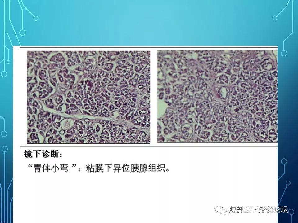 【病例】胃异位胰腺1例CT影像