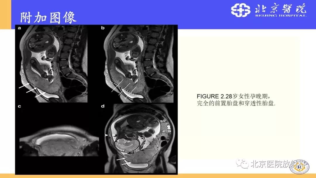 【PPT】胎盘从正常变异到植入异常与恶性肿瘤的MRI评估