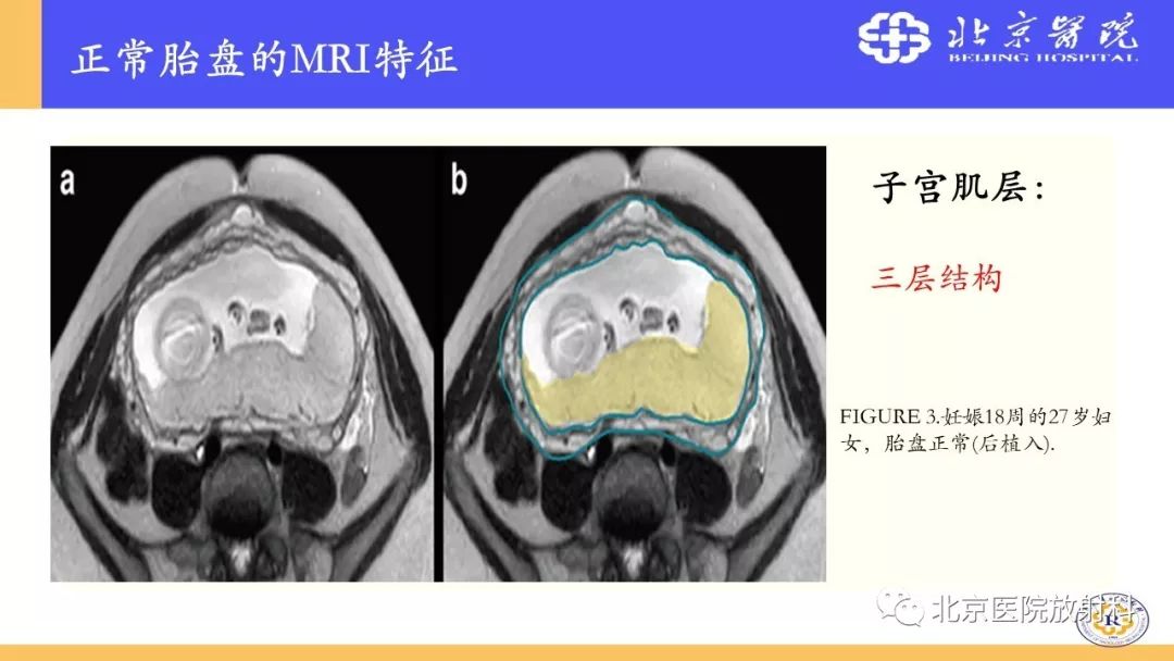 【PPT】胎盘从正常变异到植入异常与恶性肿瘤的MRI评估