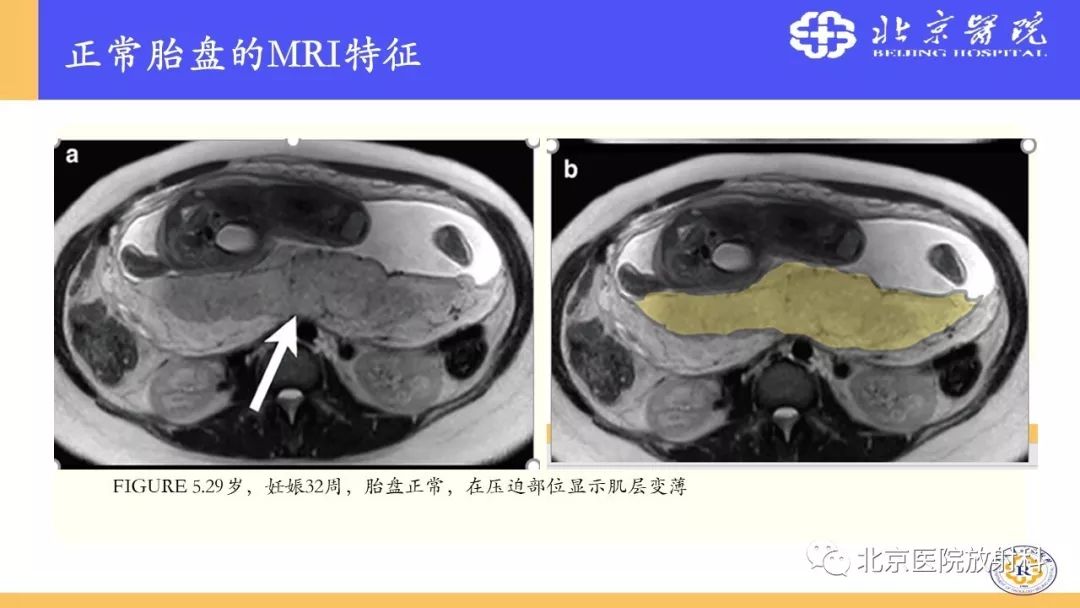 【PPT】胎盘从正常变异到植入异常与恶性肿瘤的MRI评估